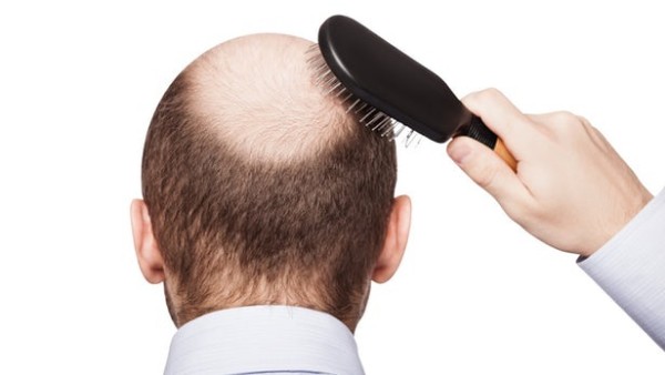 Dấu hiệu rụng tóc do nội tiết tố nam và cách khắc phục